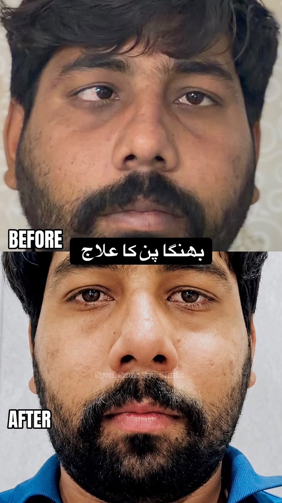 Squint Eye Surgery