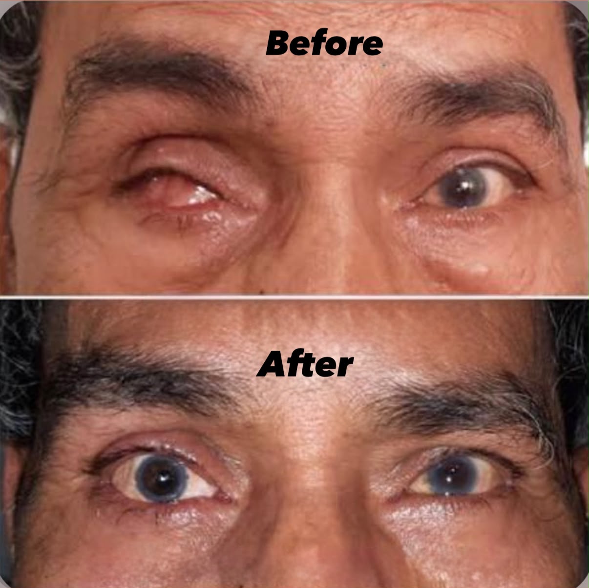 Prosthetic Eye